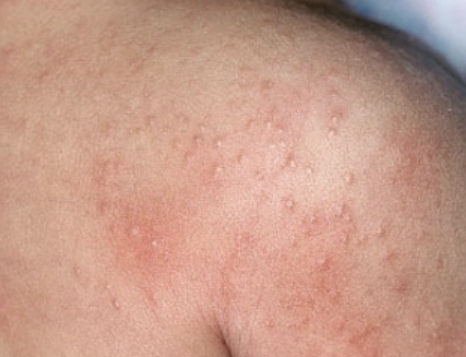 땀띠 가라앉히는 방법 2