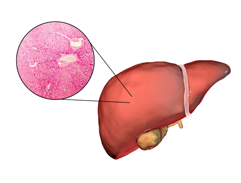 지방간 원인 증상