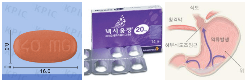 넥시움정, 역류성 식도염 사진