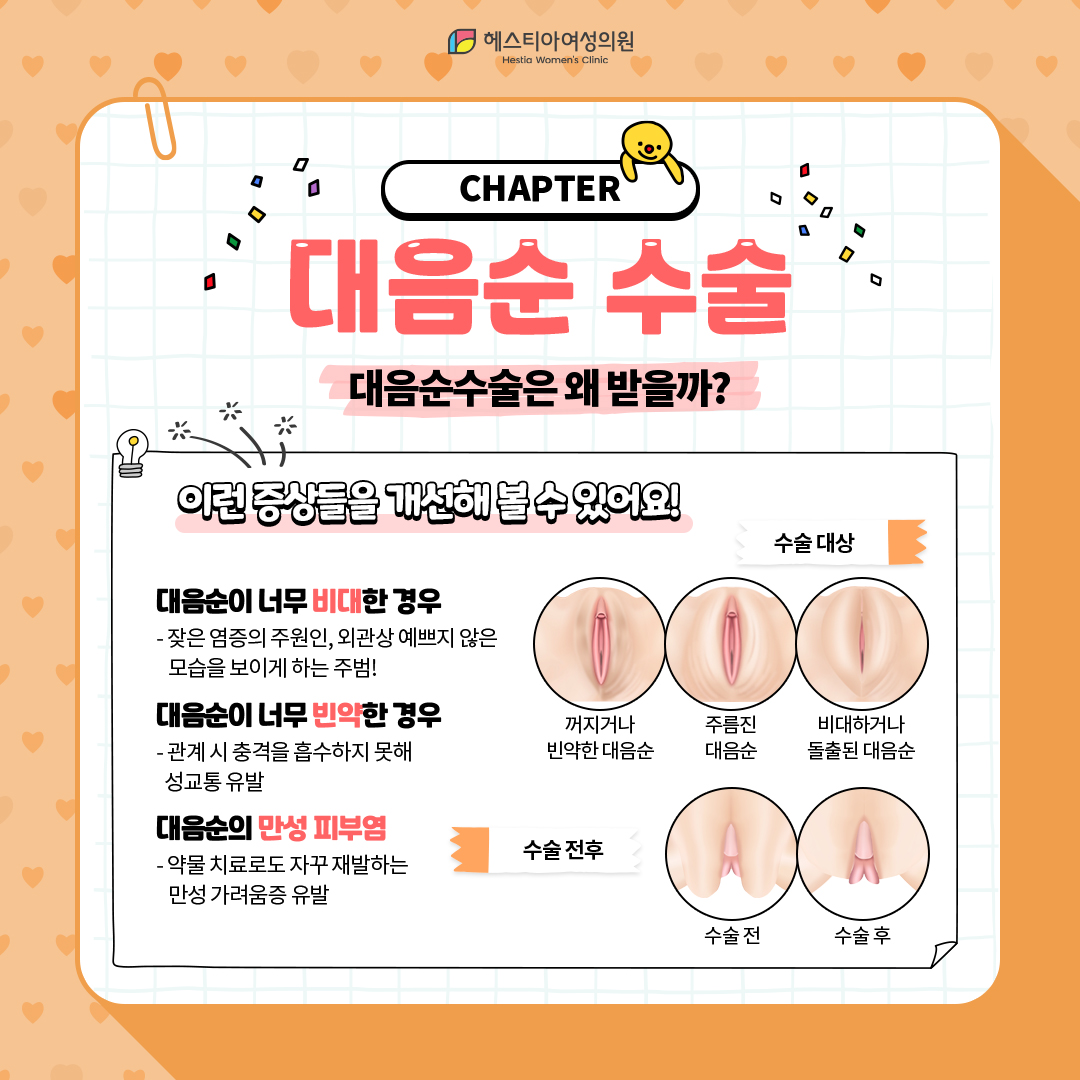 대음순수술은 왜 받을까?