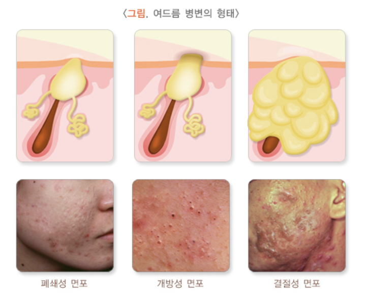 여드름 병변의 형태