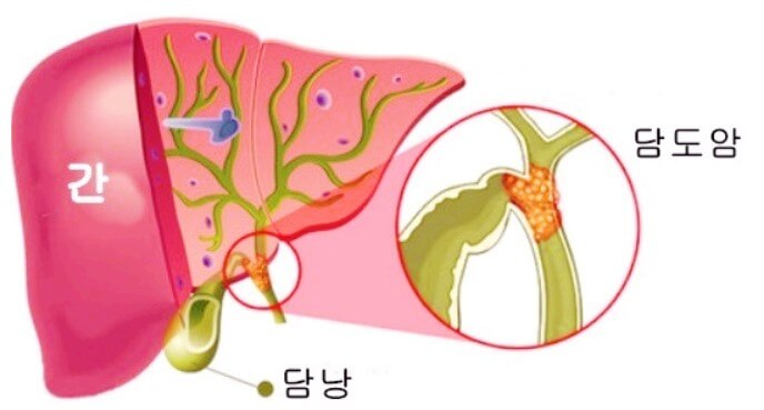 담도암-이란