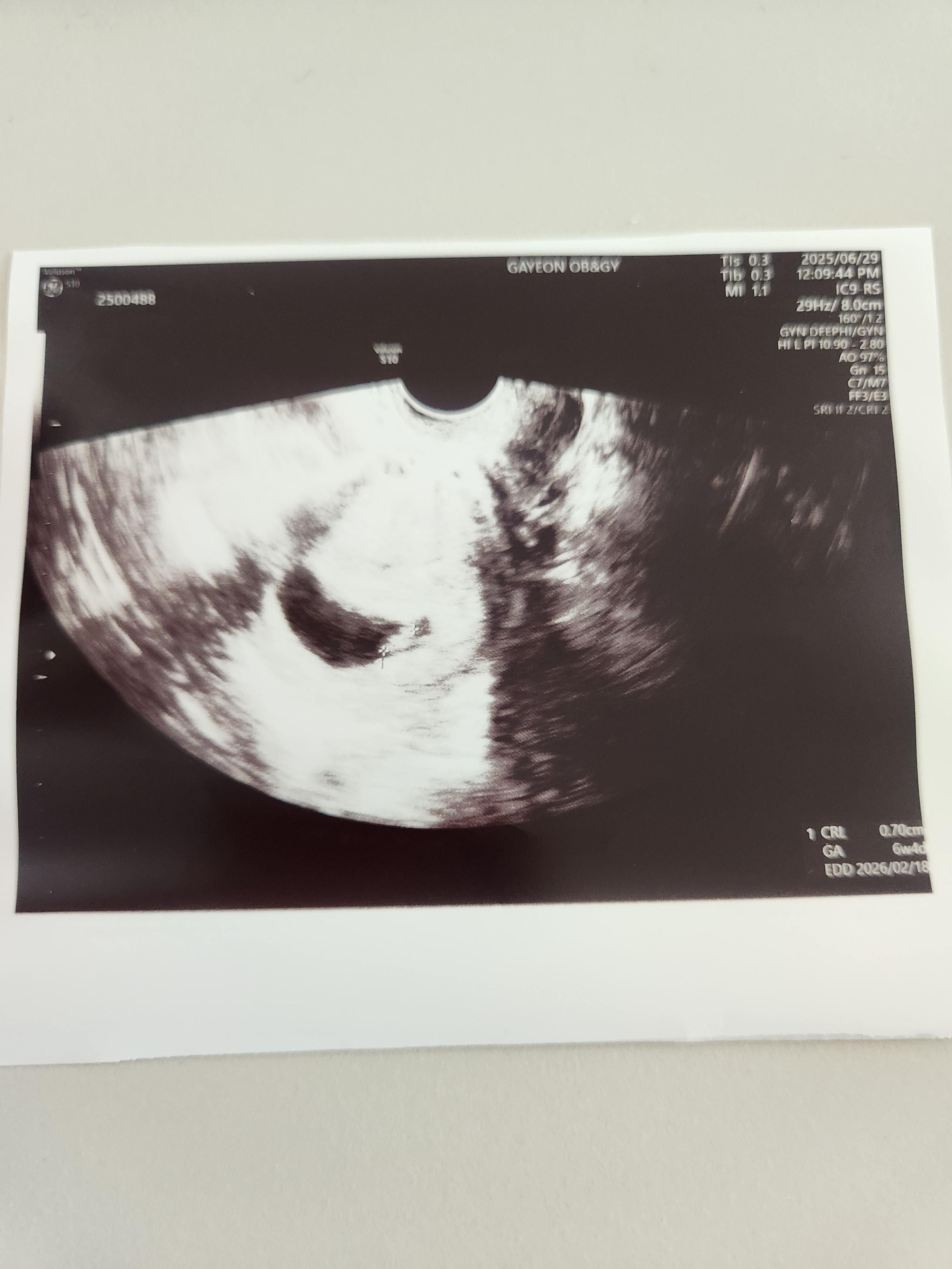 임신 6주차, 6주4일차 초음파