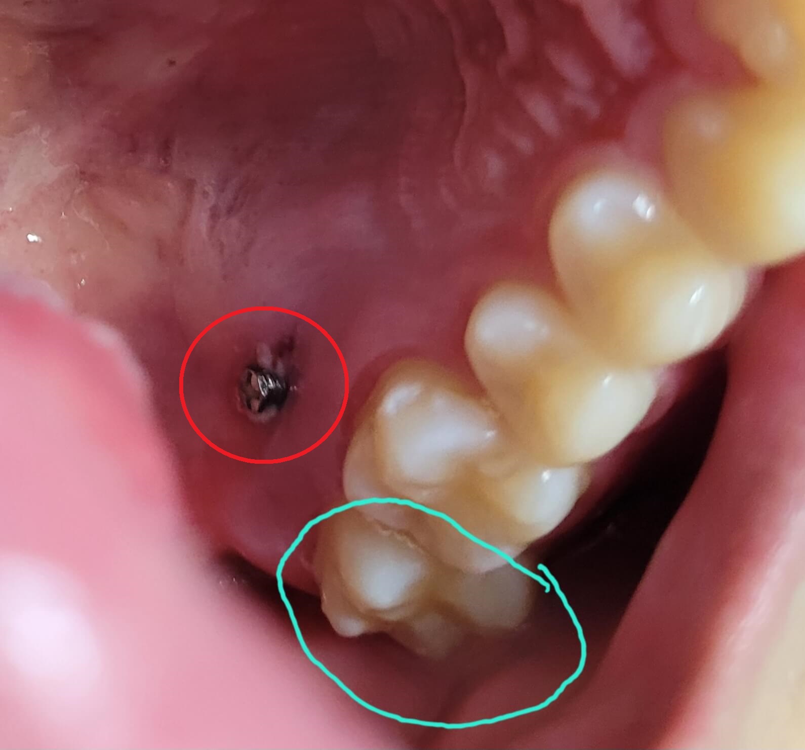 부정교합 가위교합 과개교합 치아교정 후기9