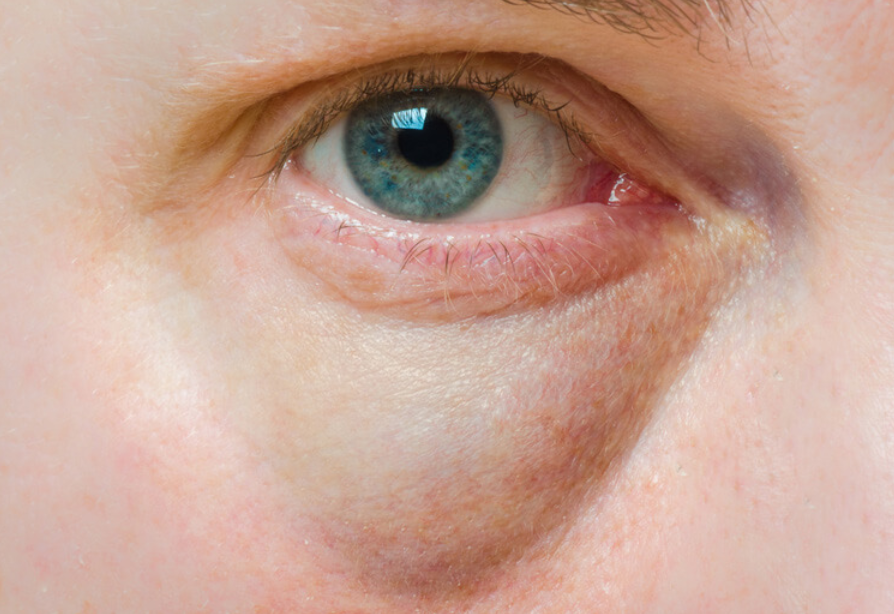 하안검 회복기간