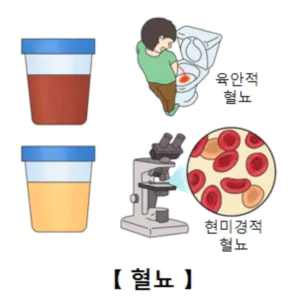 혈뇨-사진