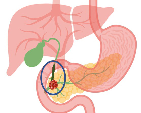 췌장암 초기증상