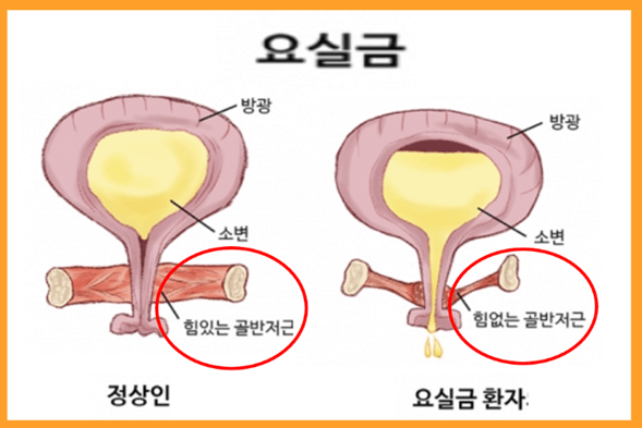소변이-자주-마려운-증상