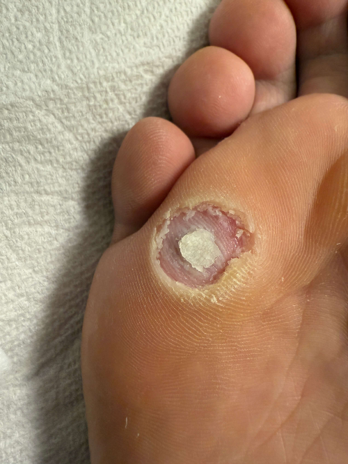 사마귀-첫번째-뚜따-사진