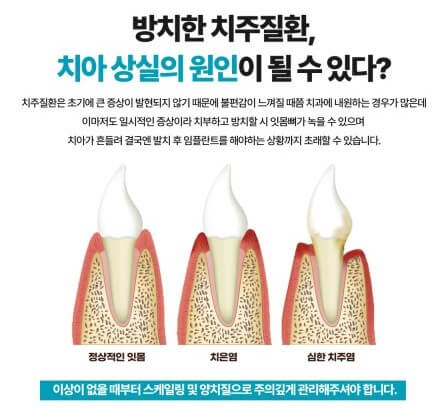 치주질환