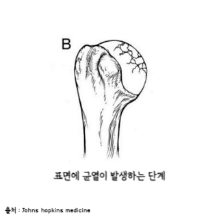 어깨통증원인