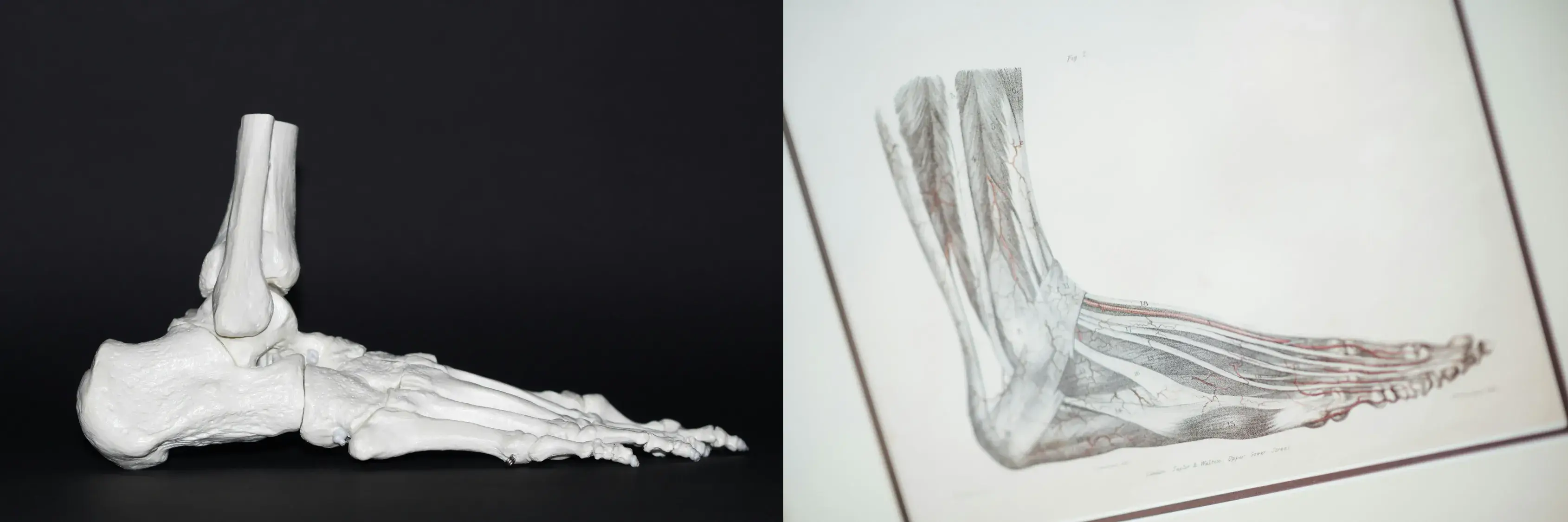 발목인공관절치환술 비용 및 지원금