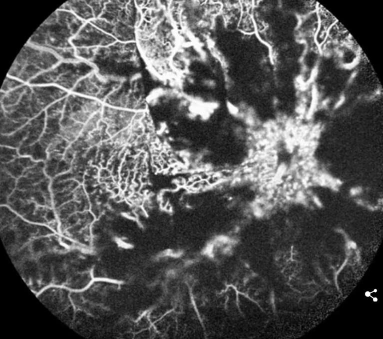 저런! 비아그라 때문에 실명을? The little blue pill may make it hard... to see! Man, 32, goes blind in one eye after using Viagra