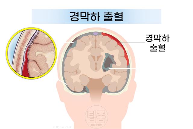 뇌혈관 터짐 위치 뇌출혈 종류 경막하출혈