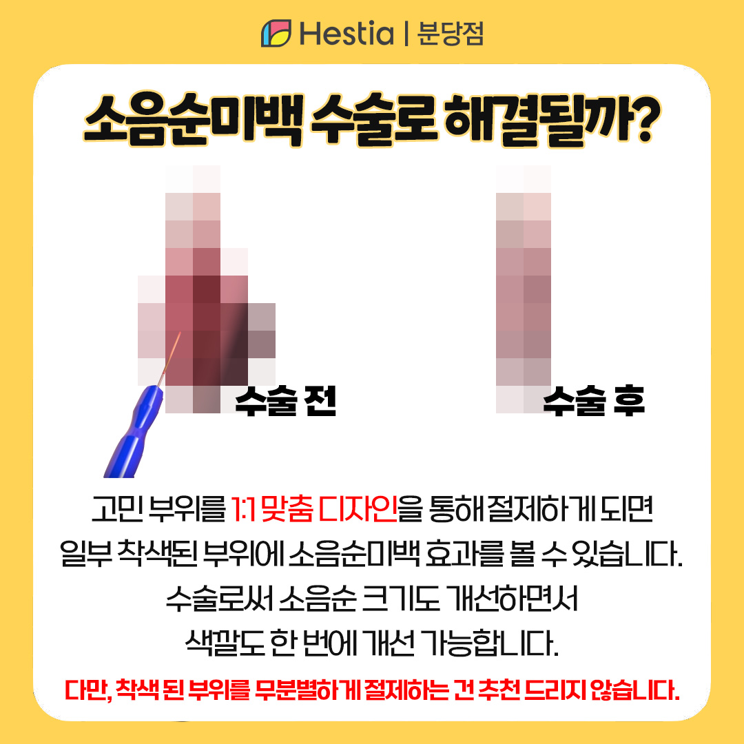 소음순미백 소음순 착색 생식기 가려움증 소음순미백 수술로 개선하는 법