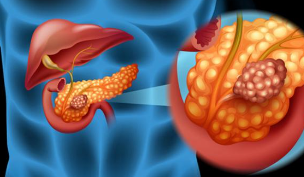 췌장암-이미지