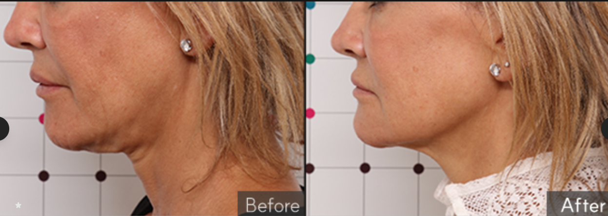 온다리프팅6만줄가격 통증 효과 부작용 이중턱 심부볼 타이트닝 전후 차이 세밀하게 비교 분석하기