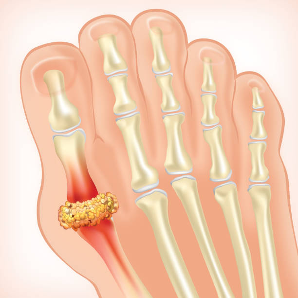대표적인 증상은 엄지발가락 관절의 극심한 통증과 부종