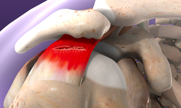 회전근개파열 수술후 회복기간