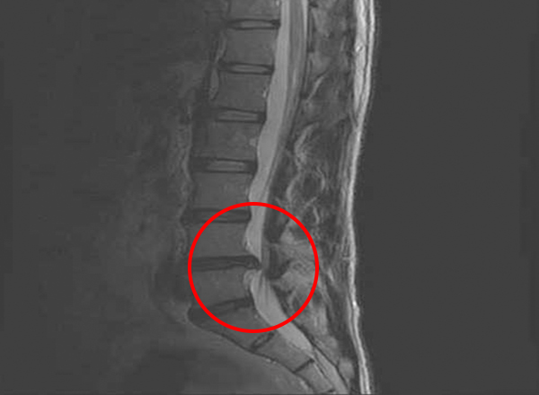 허리디스크 수술 전 MRI 판독법 초보자 가이드