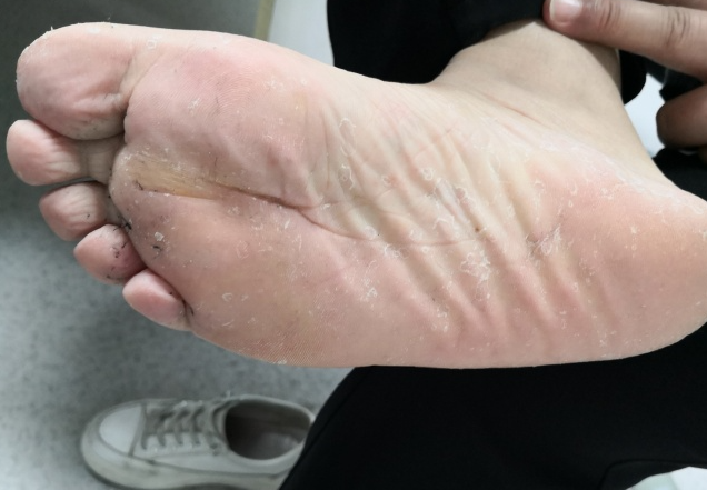 무좀약 PM 피엠 외용액 바르고 왜 발껍질이 벗겨지지?