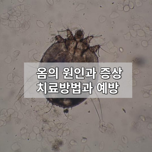 옴의 원인과 증상