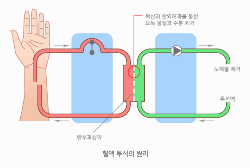 혈액 투석의 원리 이미지사진