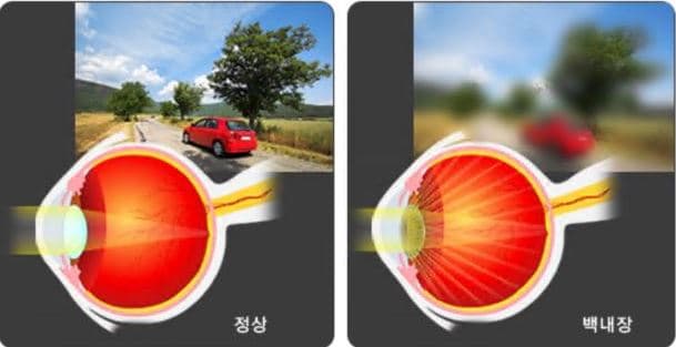 백내장 수술비용