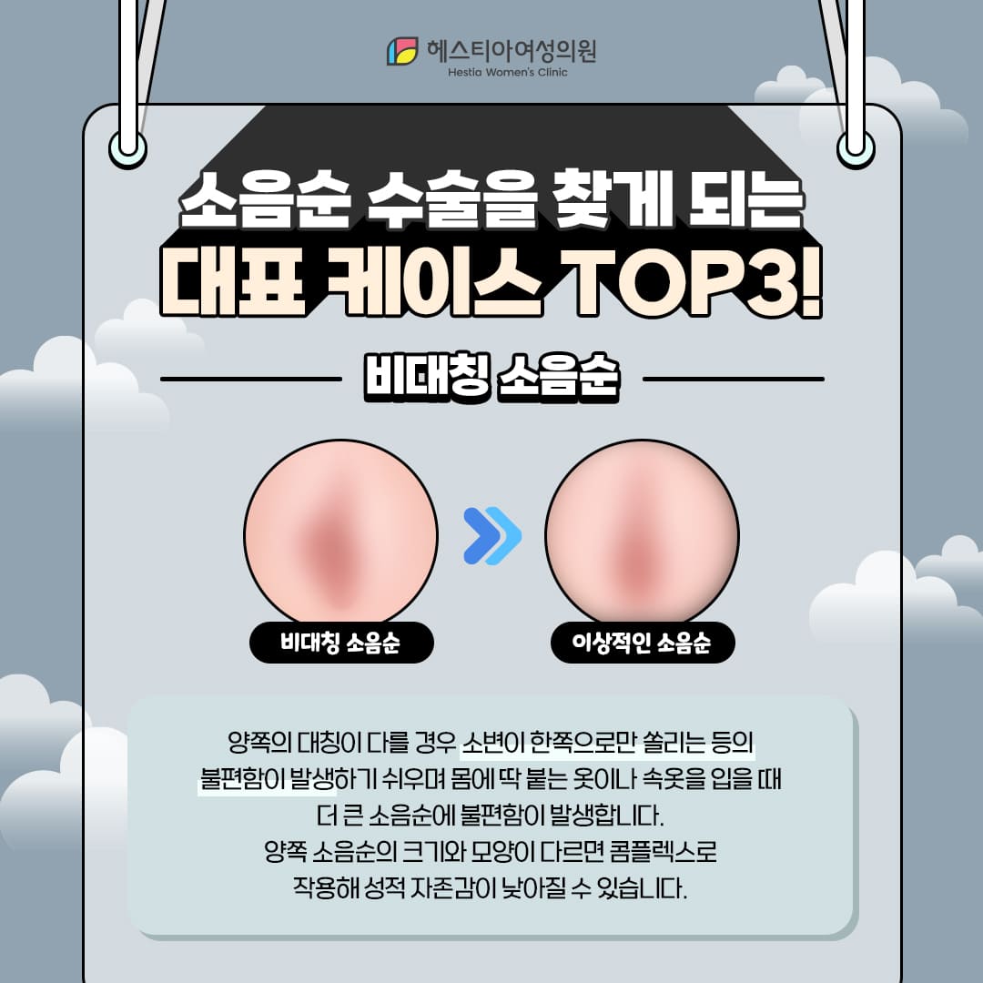 소음순수술을 찾는 소음순변형 첫번째 : 비대칭소음순