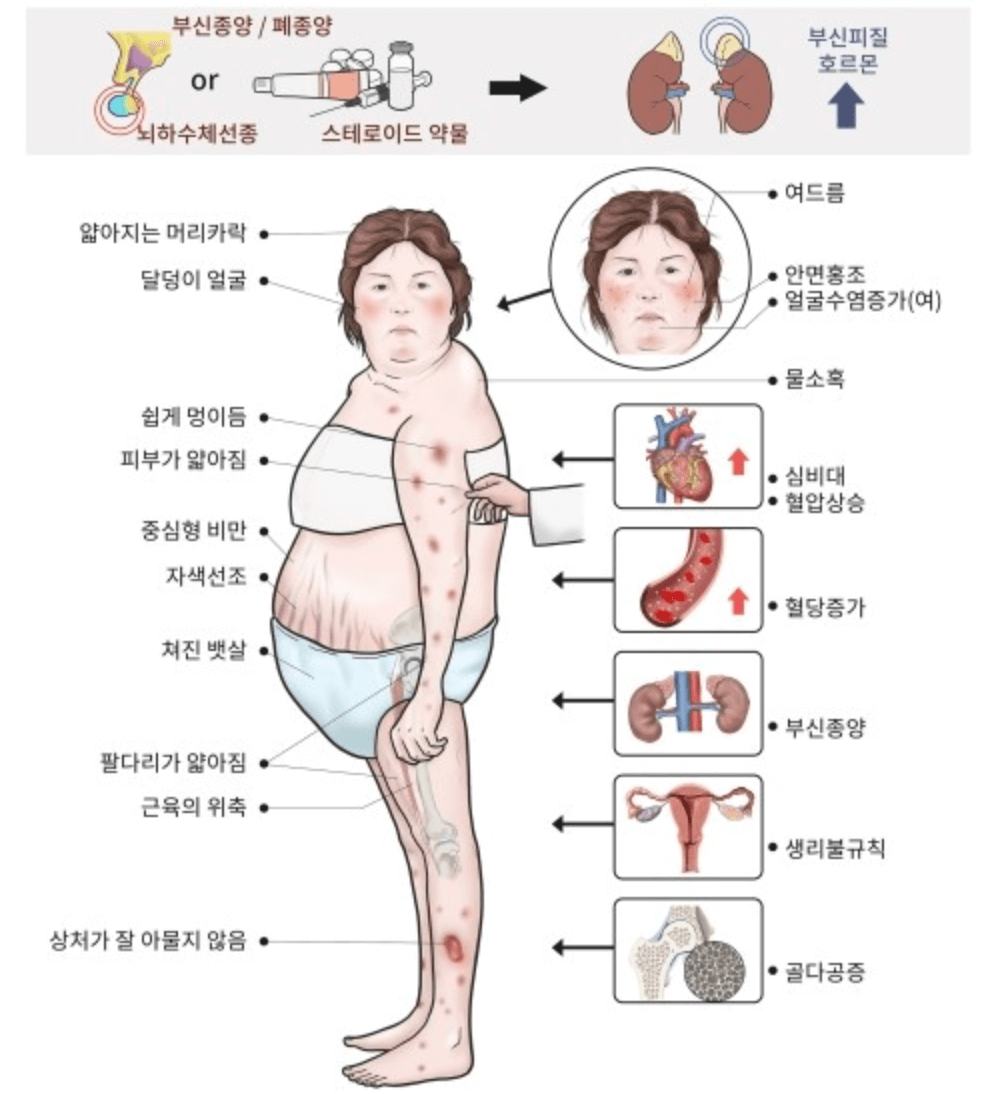 쿠싱증후군 증상