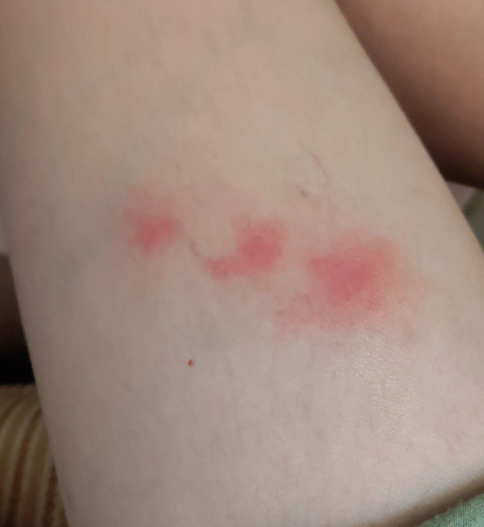 등산 갔다가 벌레 물림 부음, 따가움 때문에 벌레약 다 써보고 평가해 봤다