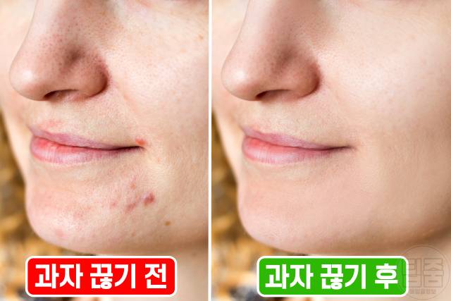 과자 끊기 효과 한달 후 피부 염증