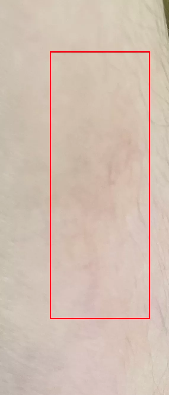 건선-자국-붉은-경우-실제-사진