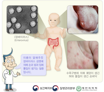 수족구 원인과 증상