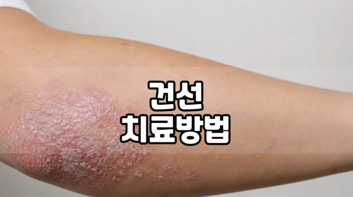 건선 치료방법