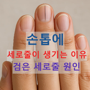 손톱에 세로줄이 생기는 이유와 검은 세로줄 원인