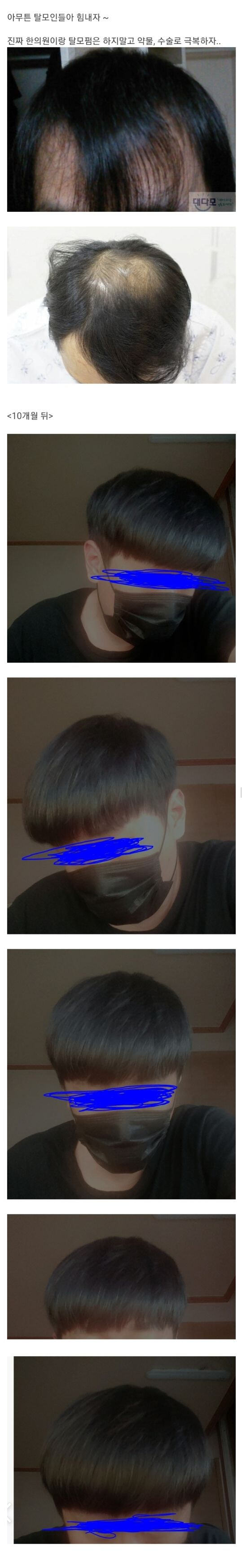모발이식 후기