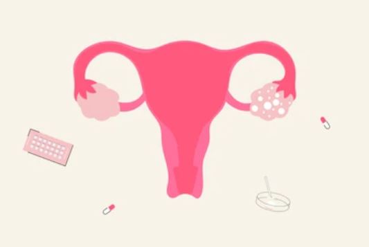 다낭성 난소 증후군 치료방법