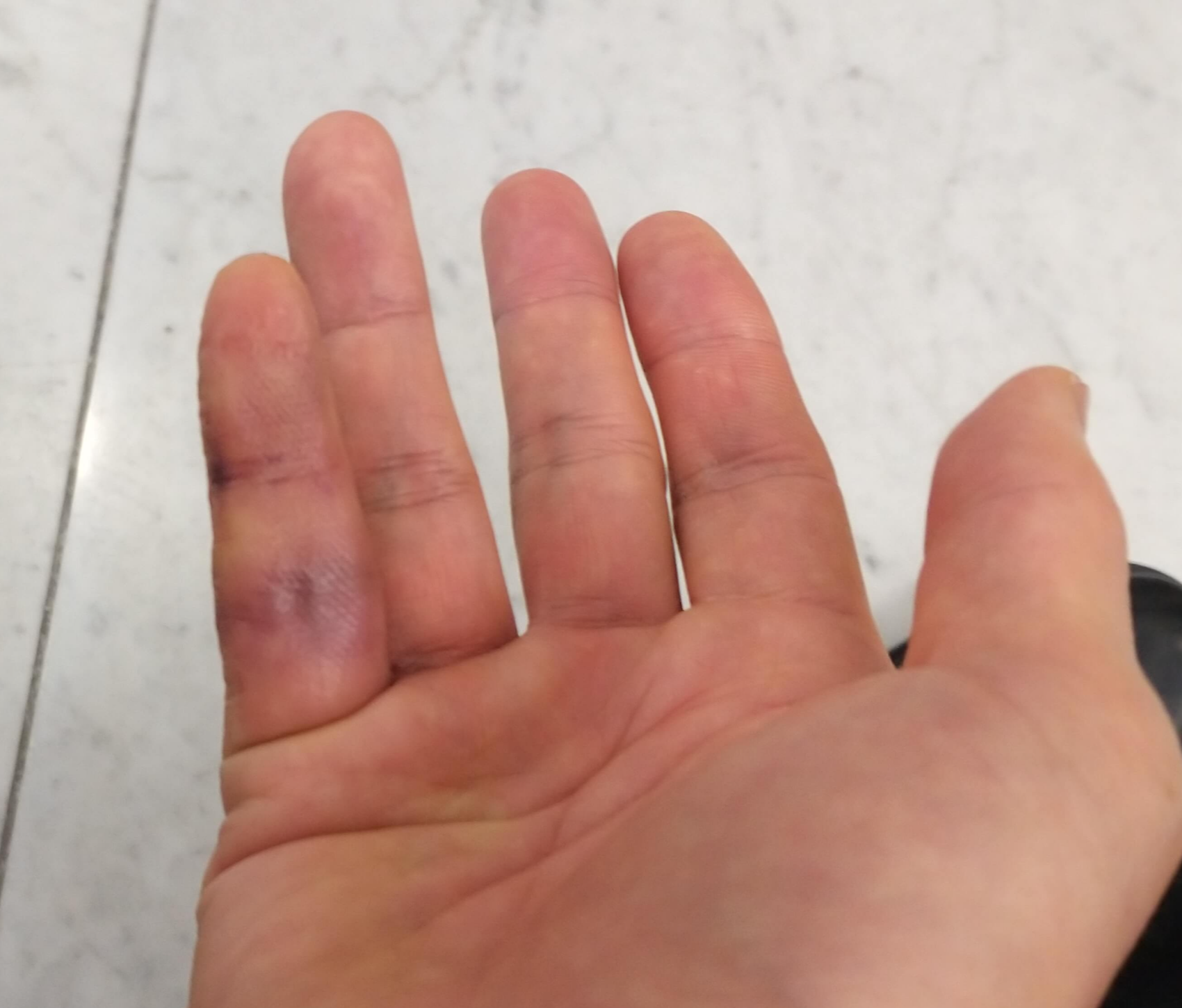 2월3일손가락부은사진2