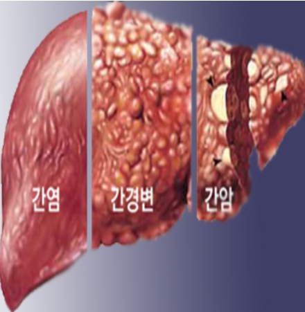 간질환에 따른 간의 상태모습 사진