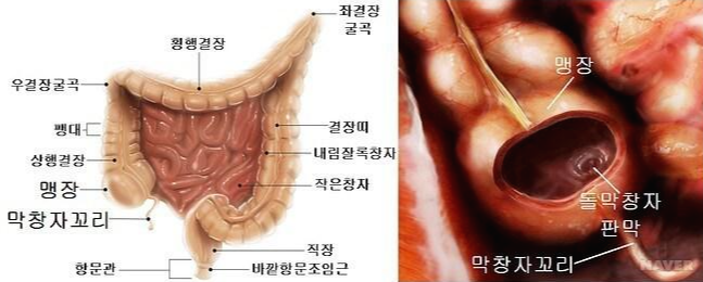 맹장염 초기 증상 5가지 및 맹장 위치