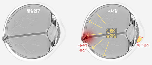 녹내장 수술 비용&amp;#44; 초기증상