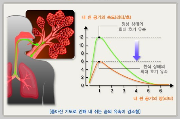 일반 천식과 기침형 천식의 차이점 천식 완화에 도움이 되는 음식 7가지