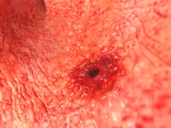 위궤양 (Gastric Ulcer): 원인, 증상, 치료 및 예방법