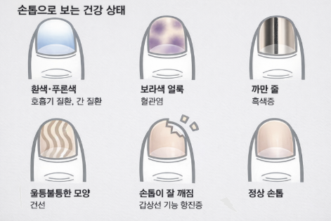 손톱 검은 세로줄 울퉁불퉁 생기는 이유 4가지 흑색종 증상 및 손톱 세로줄 없애기 영양제 추천 건강 상태 체크법