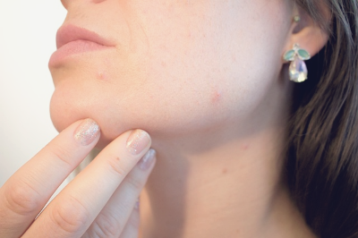 기미 없애는 방법 10가지 화장품 추천