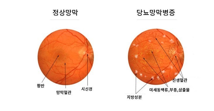 실명을 부르는 4대 망막질환 &ndash; 황반변성, 당뇨망막병증, 망막박리, 망막혈관폐쇄 총정리 관련 사진