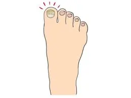 무좀 원인과 증상
