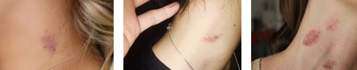 키스마크 가리는 방법