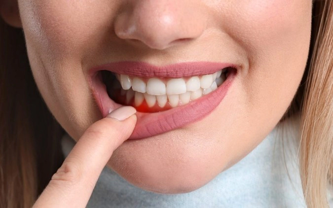 치은염 치료방법 영양제 추천